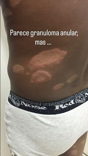 A hanseníase pode ser confundida com várias doenças. #hanseniase #doencadepele