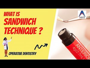 What is sandwich technique | Operative Dentistry