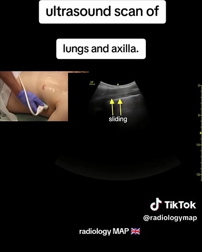 Ultrasound scan of axilla and lungs ##ultrasoundscanofaxilla #lungssonography #radiologymap #fullabdominalultrasoundseries #thoracicregionsonography