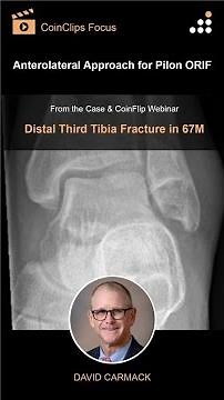 Anterolateral Approach for Pilon ORIF