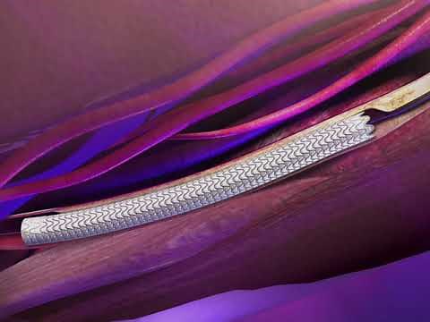How a Vascular Surgeon treats Peripheral Artery Disease with a Gore Viabahn stent graft.