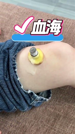 Master Essential Acupoint Moxibustion Techniques for Health