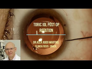 TORIC IOL POST OP ROTATION