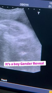 It’s a baby boy gender reveal ultrasound scan | Dr.aneela manzoor-RPH