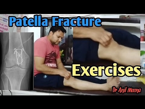 Patella Fracture Recovery Exercises | Patella Fracture Exercises | Patella Fracture Physiotherapy