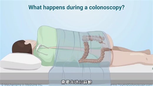 肠镜检查过程，3D演示。。