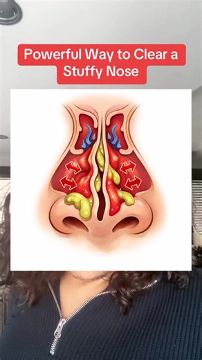 Mourab Maraby on Instagram: "Powerful Way to Clear a Stuffy Nose #stuffynose #blockednose"
