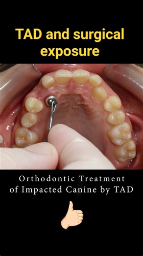 Braces can change smiles! TAD and Impacted canine Before and After #dentist #braces #orthodontist