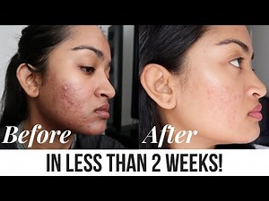 Acne Treatment Facial Peel + Before and After | SilasQiu