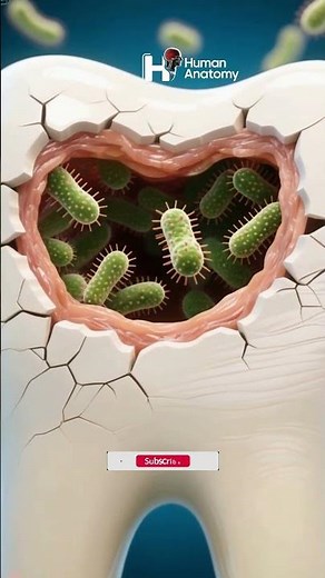 Bacteria Inside a Cavity: How Tooth Decay Spreads