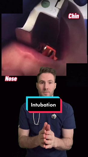 Placing a breathing tube. #intubation #breathingtube #emergencymedicine #medicalprocedure