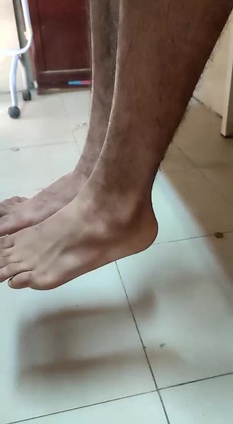 Understanding and Treating Peroneal Tendon Subluxation