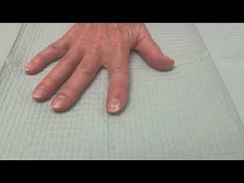 Right Index Finger Mucous Cyst Excision with Local Advancement Flap