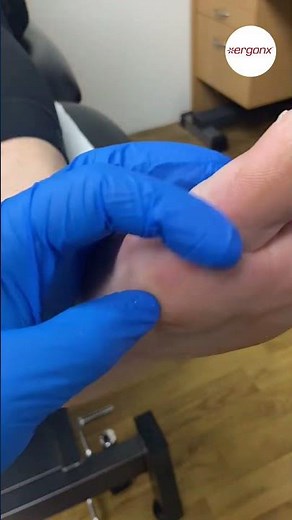 Ultimate Bunion Callus Removal: Pain Relief Tips for Steel Toe Boot Wearers #FootCare #BunionRelief