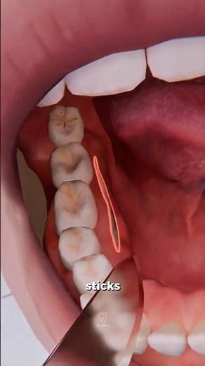 When Braces Aren’t Enough: Underbite Surgery Explained🦷 #dentist