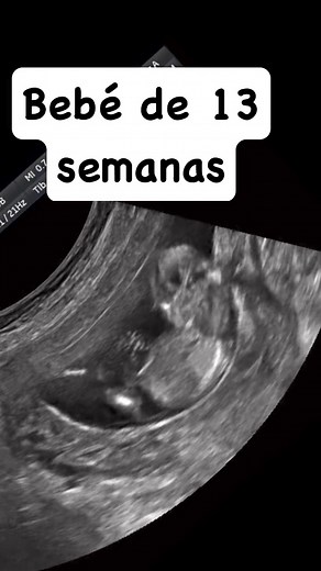 Bebé de 13 semanas | Dr. Gustavo Gonzalez, Ocotlan