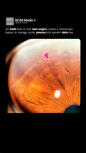 The Micro-Laser Saving Sight 🤯👁️