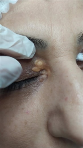 Xallarin təmizlənməsi👆 Əlaqə:📱0708303066 #kesfet #kesfetteyiz #kəşfet #foryoupage❤️❤️ #xal #ziyil #papilloma #papillomavirus #qadin #qadinlar #xanimlar #qizlar #fupシ #hpv #gen #izleme #bey #oglanlar #kadinlar #baking #baku #baki #azeri #azərbaycan #kosmetik #cosmetology #trend #trending #statusvideo #fyp #viralvideo #tiktokviral #dermatoscopia #laser #plasma #dermatoscopy #xallarinyandirilmasi #xallaringoturulmesi #xallarason #xallar #xallarindermatoskoplabaxilmasi #beyen #like #likes #azeri #