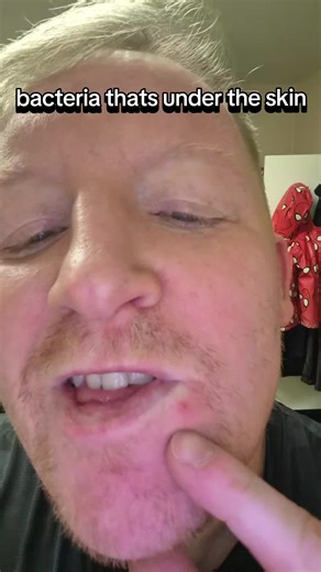 Effective Solutions for Zits and Pimples