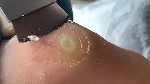 Callus removal from feet&Foot scraping dead skin【Xiao Yan pedicure】#stress 816 | Xiao Yan Pedicure
