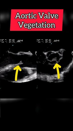 Aortic Valve vegetation on Echocardiogram- Echocardiography for Beginners #heart