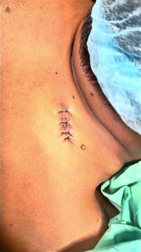 Back Lymph Node