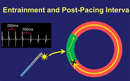 Entrainment Mapping - The Post-Pacing Interval - Dr. Joshua Cooper