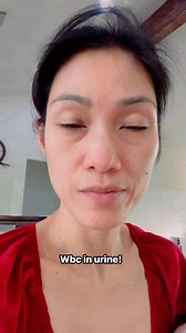 Wbc in urine. | DR.F