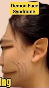 The "Demon" Face Syndrome