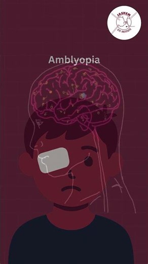 Is Your Child’s Brain Favoring One Eye? Understanding and Treating Amblyopia