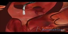 Cardiology Medical Animation - Deployment of...