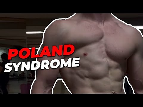 POLAND SYNDROME (my missing pec) EXPLAINED!