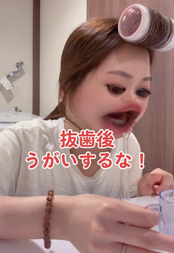 抜歯後の注意点：うがいは絶対ブクブクNG