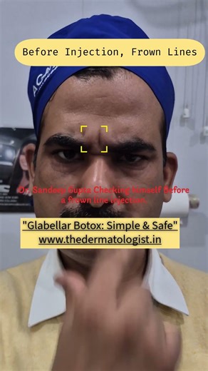 Glabellar Botox - Dr Sandeep Gupta Demonstrates on Himself! #dermatology #medicaldisclaimer #skin