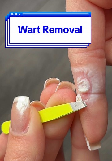 Effective Wart Removal: Satisfying Peel Process