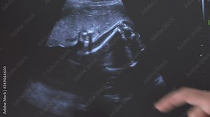 Ultrasound scan of the second trimester stages of pregnancy, closeup
