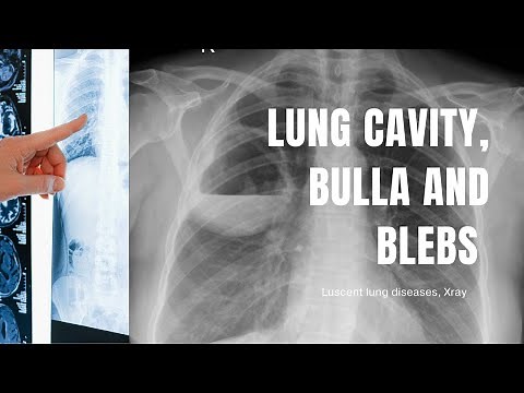 Cavity, bulla, blebs, abscess in a Chest Xray- How to differentiate?