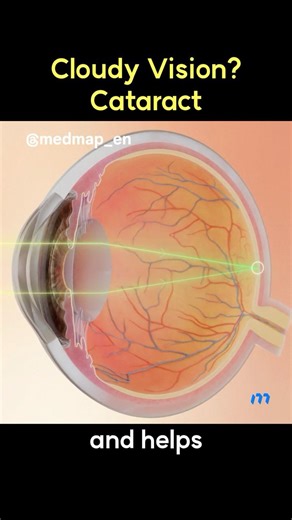 Cloudy Vision? Cataract