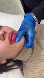 Russian volume lips  Tehnici avansate de injectare ✔️ Programări :0722296007 | Clinica Beauty Art Aesthetics | Facebook