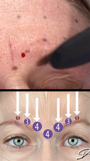 How to: corrugator Botox