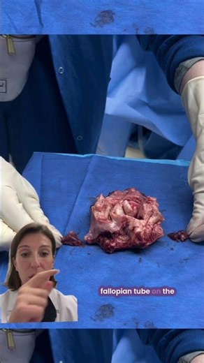 Adenomyosis vs. Fibroids: What Surgeons See #Adenomyosis