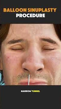Balloon Sinuplasty Procedure Explained | Sinus Relief Treatment #BalloonSinuplasty #SinusSurgery