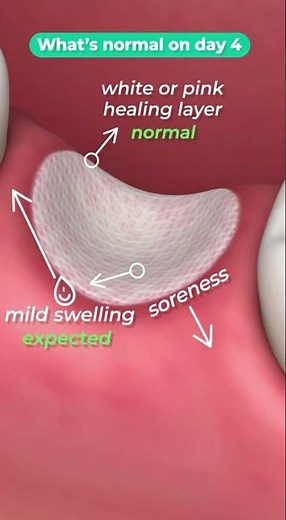 🦷 Day 4 After a Tooth Extraction: Is This Normal?
