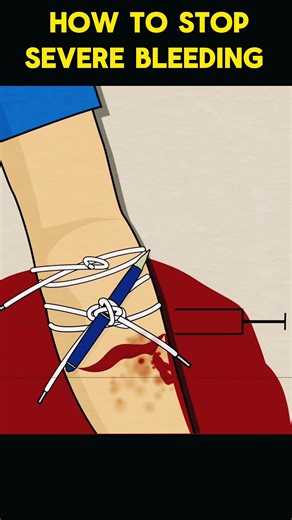 How to Stop Severe Bleeding at home first aid #bleeding #firstaid #bleeding #severebleeding #bleedingcontrol #stopbleeding #howtostopbleeding #arterialbleeding #howtocureseverbleeding