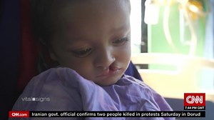 Treating Cleft Lip and Cleft Palate