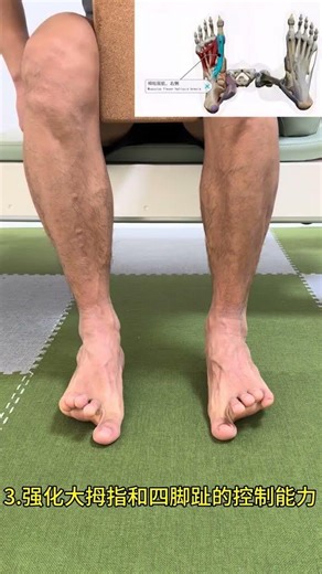 Functional arch collapse must undergo corrective training#Arch collapse#很抱歉.这段文本暂时无法提供