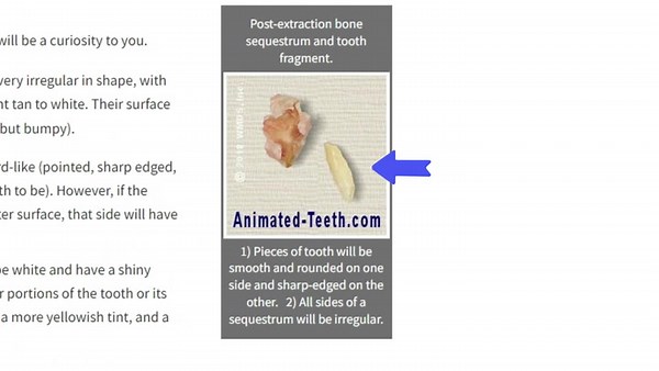 Extraction site tooth shards and bone fragments.mp4
