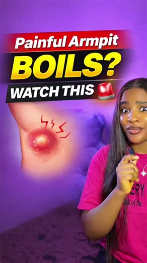 Understanding Boils in Armpits and Groin Areas