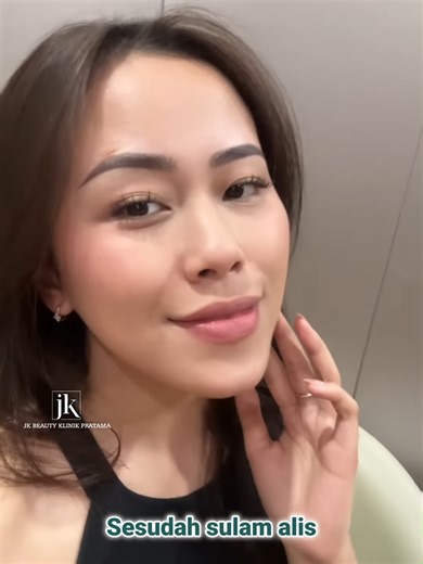 Tidak harus sulam alis semakin tebal untuk terlihat cantik. Untuk Ibu Zahra, JK Beauty Center secara langsung merancang bentuk alis yang sesuai dengan wajah beliau, dengan ketebalan yang pas agar tampilan terlihat seimbang dan alami. Setelah selesai, wajah tampak lebih segar, memiliki titik fokus yang jelas namun tetap terlihat ringan dan tidak kaku. Auranya pun menjadi lebih lembut dan awet muda. Menyambut bulan Ramadan dengan alis yang sudah rapi, tak perlu lagi khawatir setiap hari harus meng