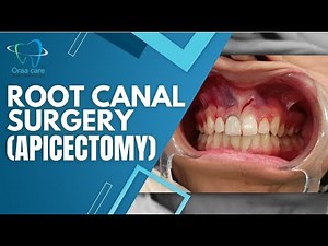 Root Canal Surgery (Apicectomy)